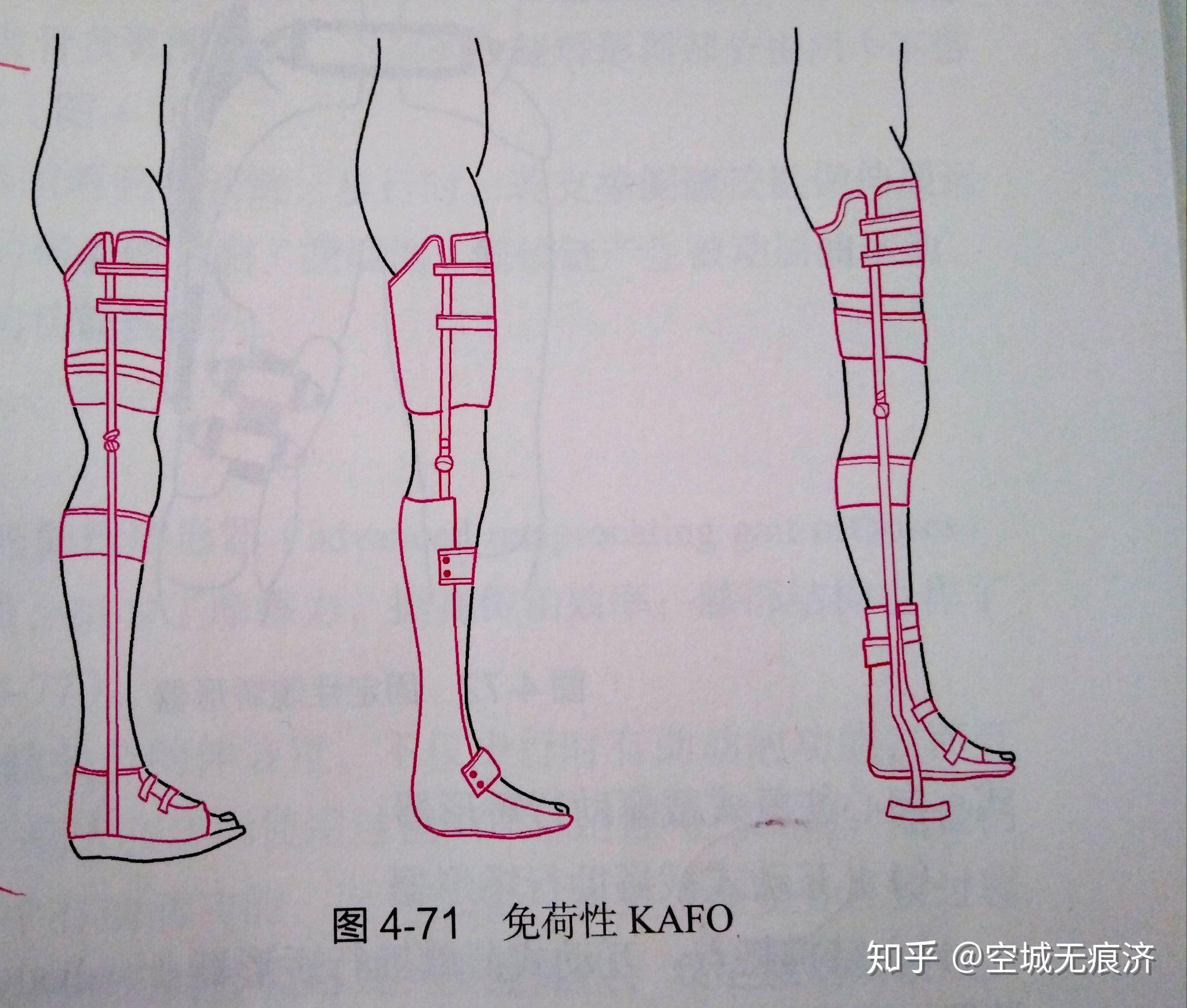 臨床康復(fù)工程學(xué) 假肢與矯形器的功能、設(shè)計(jì)與發(fā)展